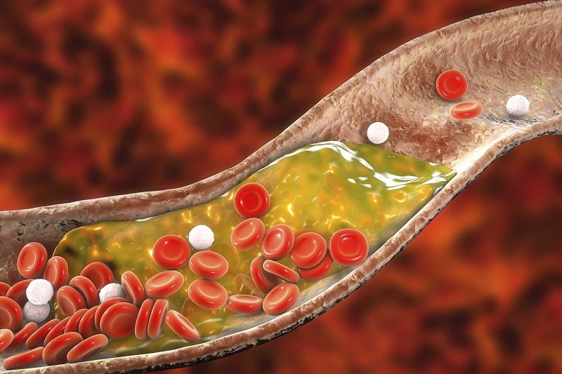 Cholesterol cao trong máu gây ra các chứng bệnh nguy hiểm đe dọa đến tính mạng